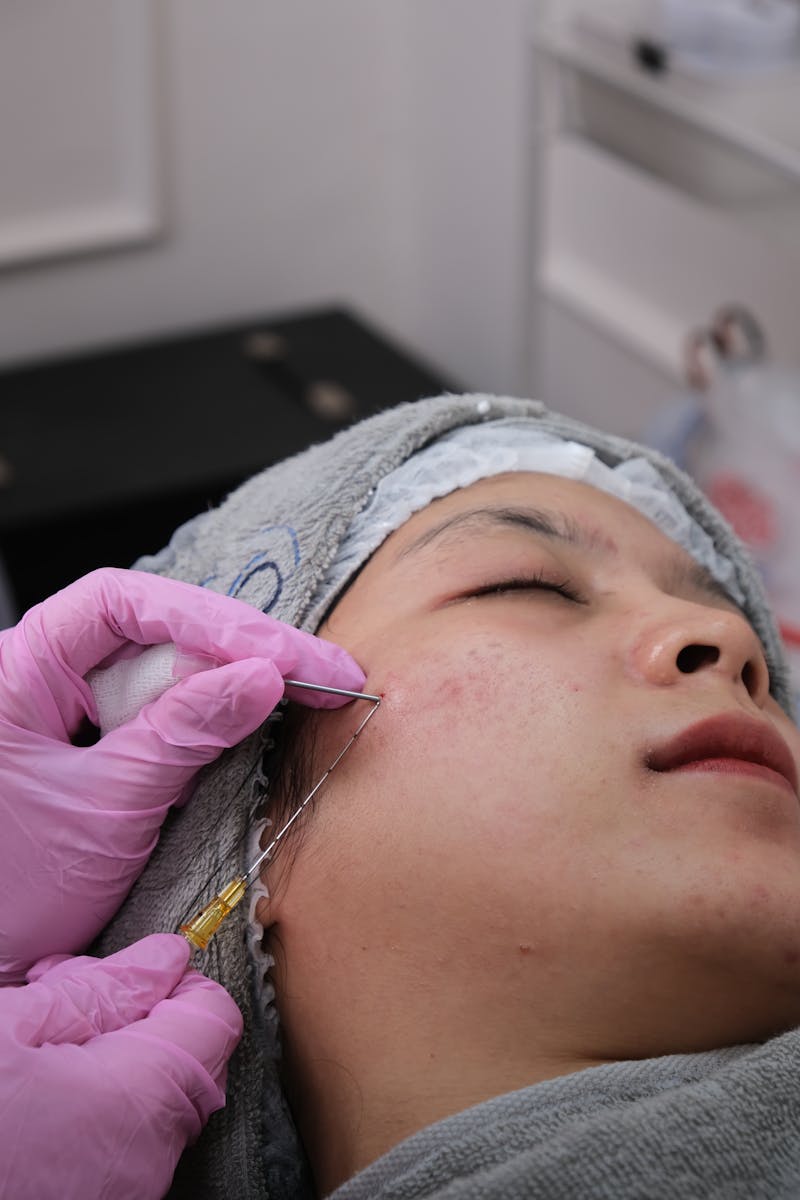 Close-up of facial treatment with microneedling procedure in a clinic setting.